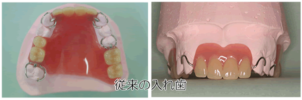 従来の入れ歯