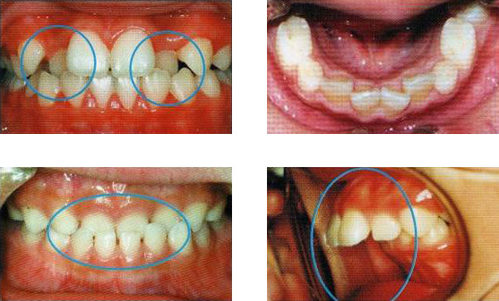 歯並びの不具合例